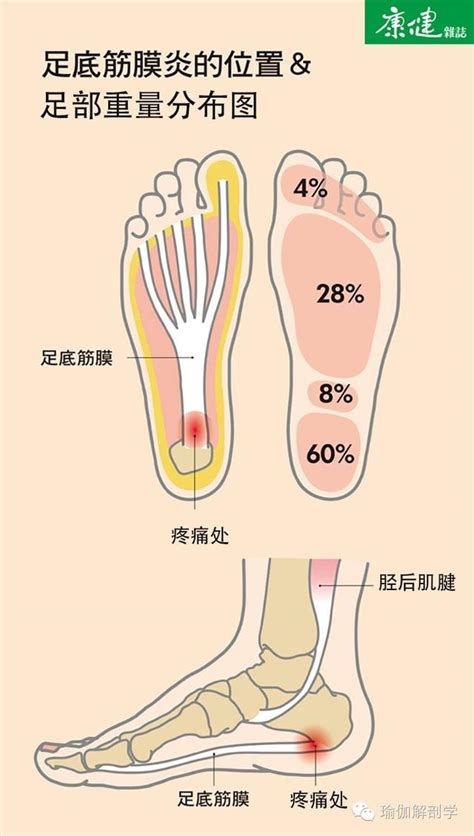 吱腳板底|腳底板痛是足底筋膜炎？腳底痛原因、位置、舒緩一次。